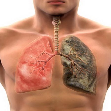 Lung Cancer